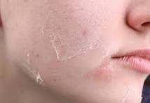  dry skin image